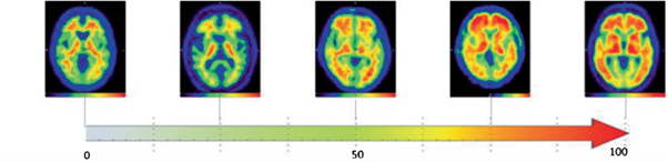 Left to right: A healthy brain at zero, the brain of a person with highly developed Alzheimer's at 100